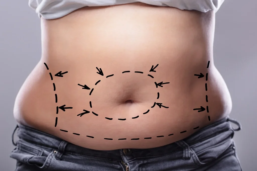 Abdominoplasty rad laguna hills ca