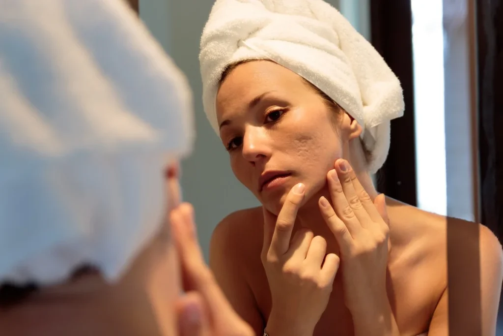 Acne Scar Treatments regenerative aesthetics and dermatology laguna hills ca