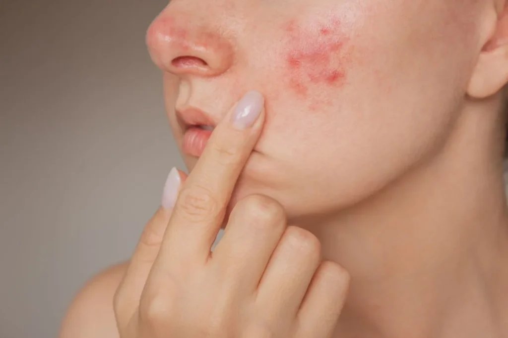 Acne and Rosacea regenerative aesthetics and dermatology laguna hills ca