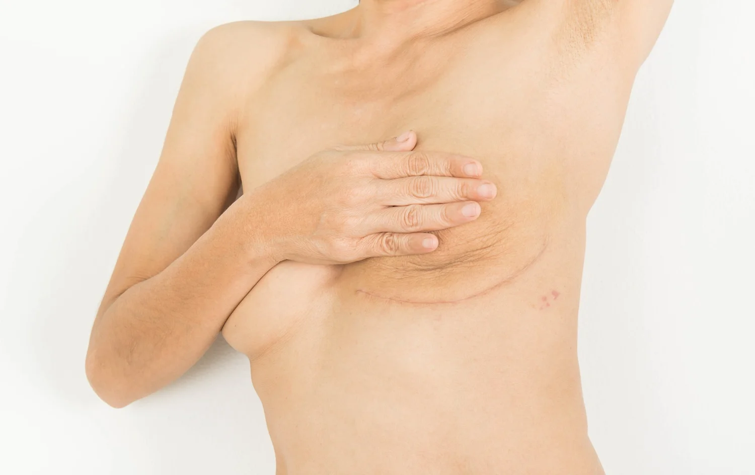 Breast Reconstruction in Laguna Hills, CA at Regenerative Aesthetics and Dermatology