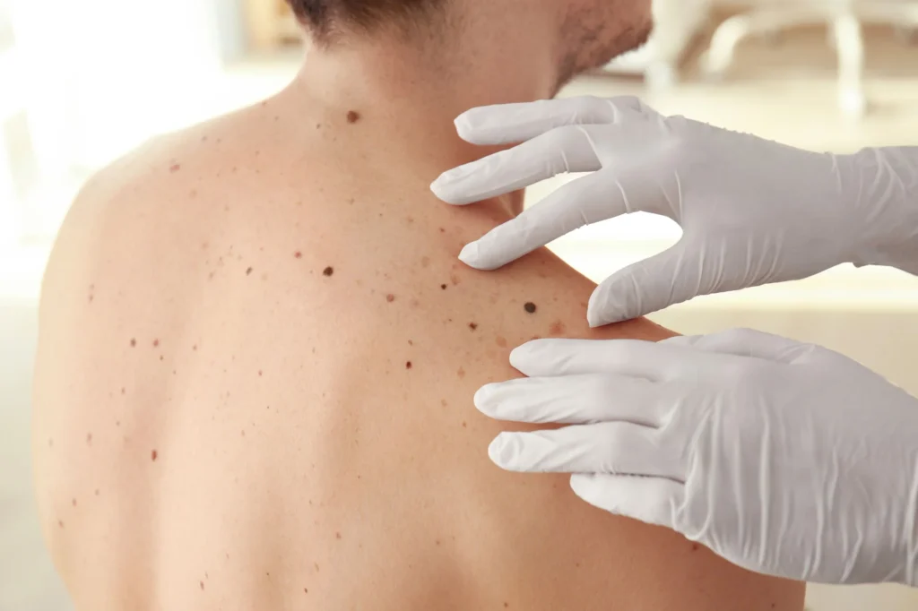 Excisions regenerative aesthetics and dermatology laguna hills ca