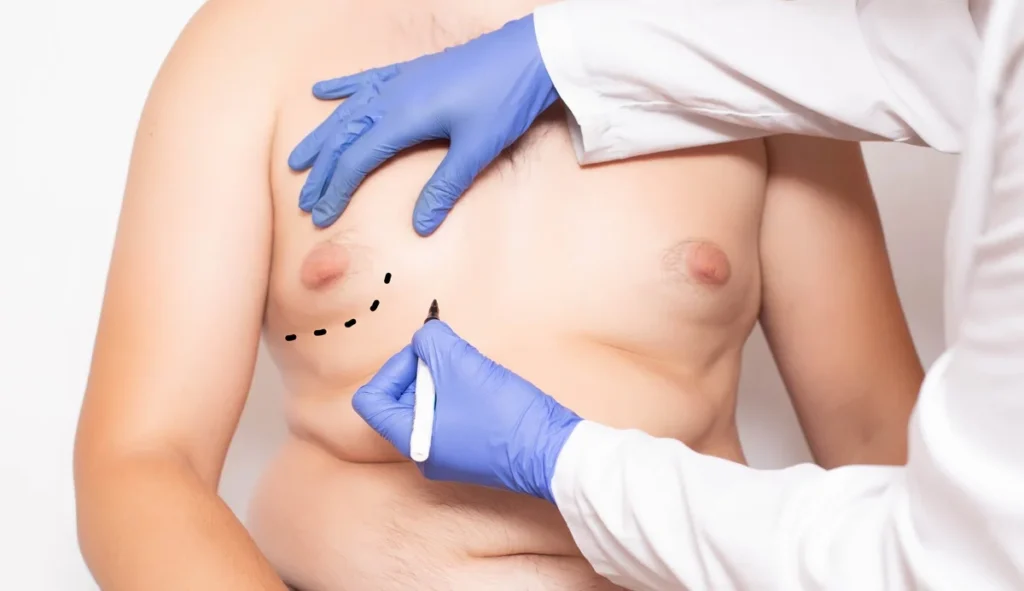 Gynecomastia in Laguna Hills, CA at Regenerative Aesthetics and Dermatology
