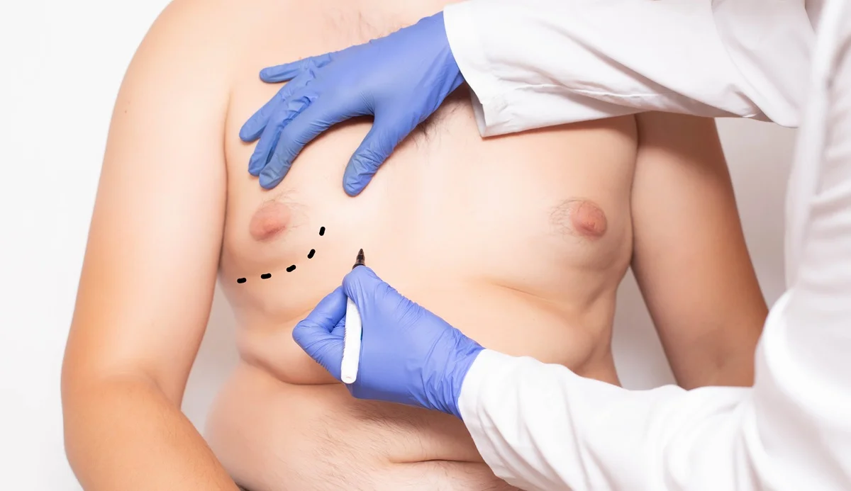 Gynecomastia in Laguna Hills, CA at Regenerative Aesthetics and Dermatology