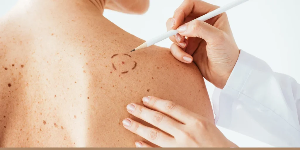 Mohs-Surgery-regenerative-aesthetics-and-dermatology-laguna-hills-ca