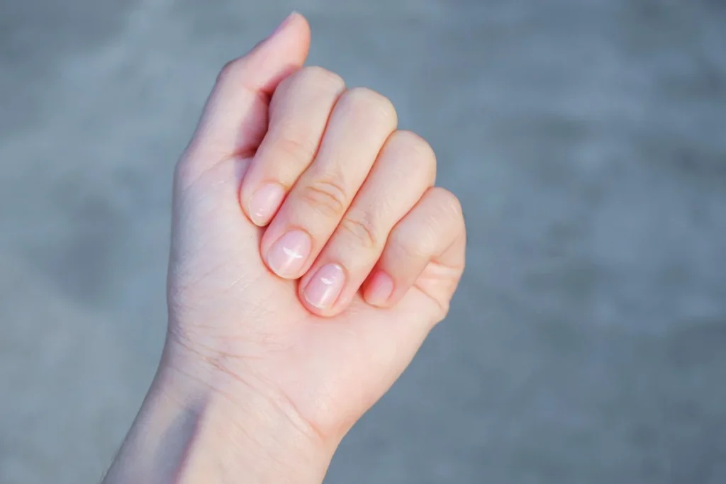 Nail-Disease-regenerative-aesthetics-and-dermatology-laguna-hills-ca