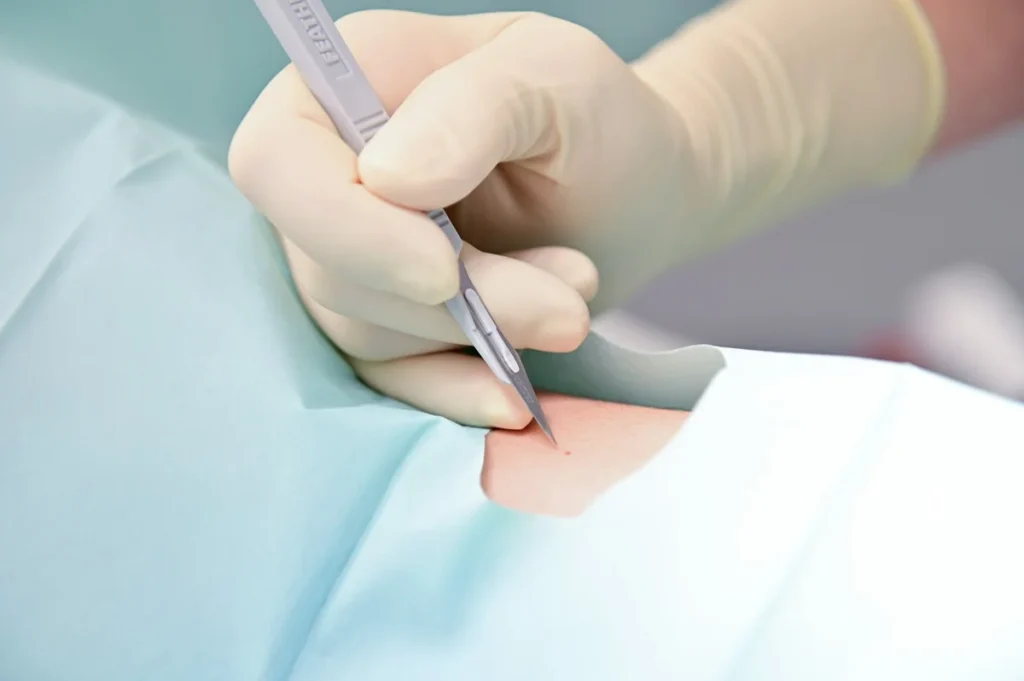 Skin Cancer Treatments rad laguna hills ca