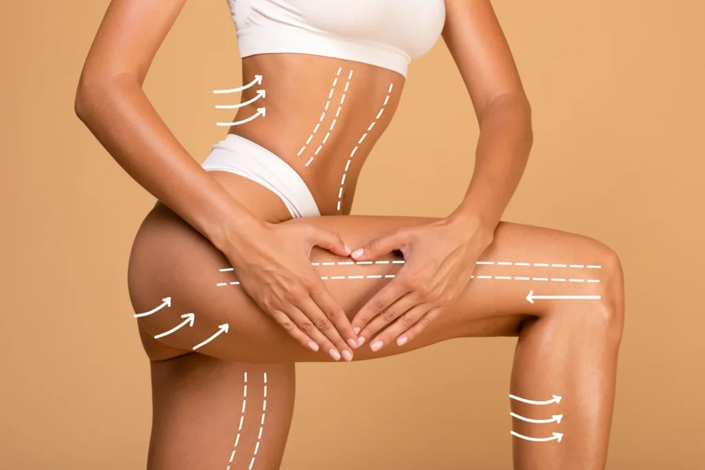 BodyTite Skin Tightening Laguna Hills