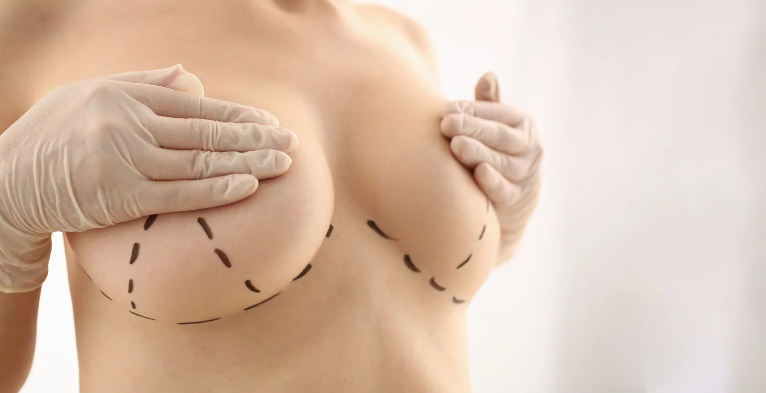 Breast Lift (Mastopexy) Service in Laguna Hills at Regenerative Aesthetics and Dermatology