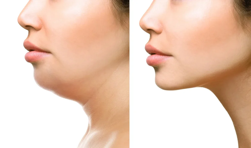 genioplasty regenerative aesthetics and dermatology rad laguna hills ca