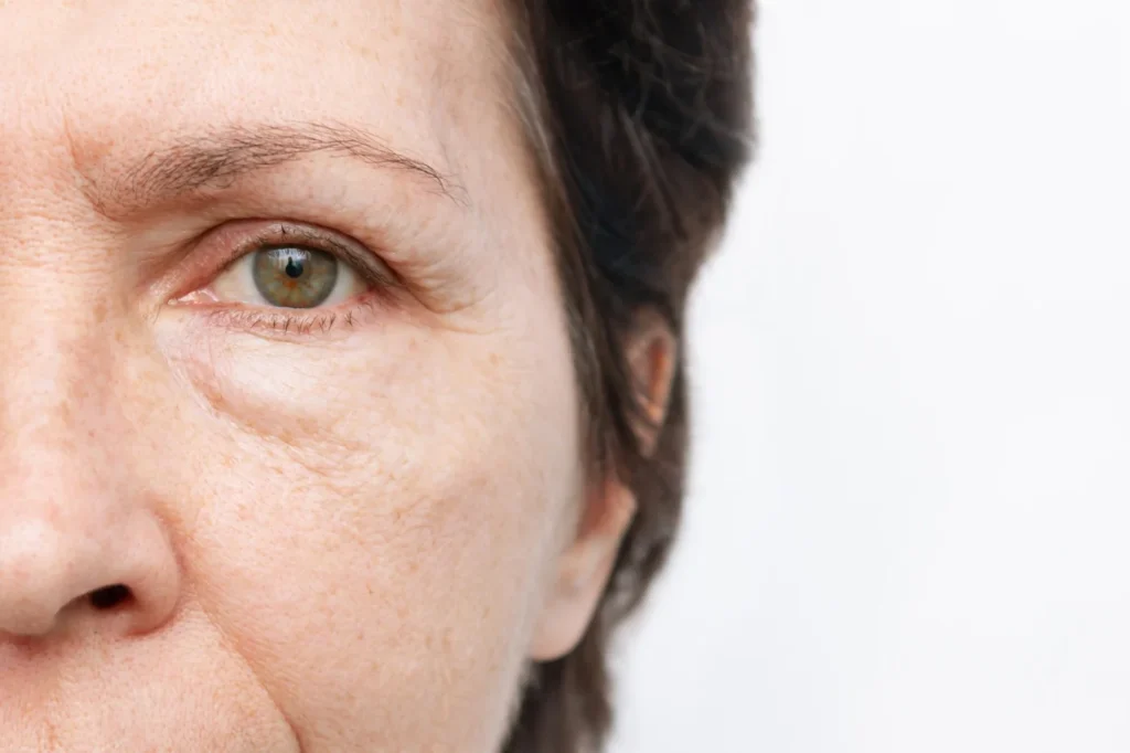 non-surgical-eyebag-regenerative-aesthetics-and-dermatology-rad-laguna-hills-ca