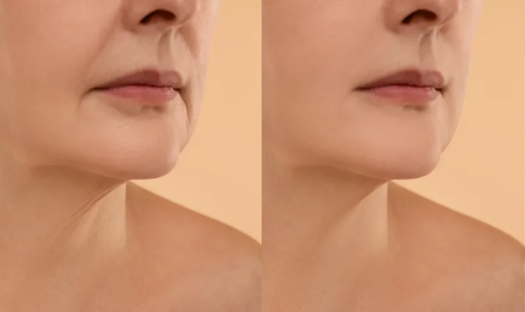 non surgical face and neck regenerative aesthetics and dermatology rad laguna hills ca