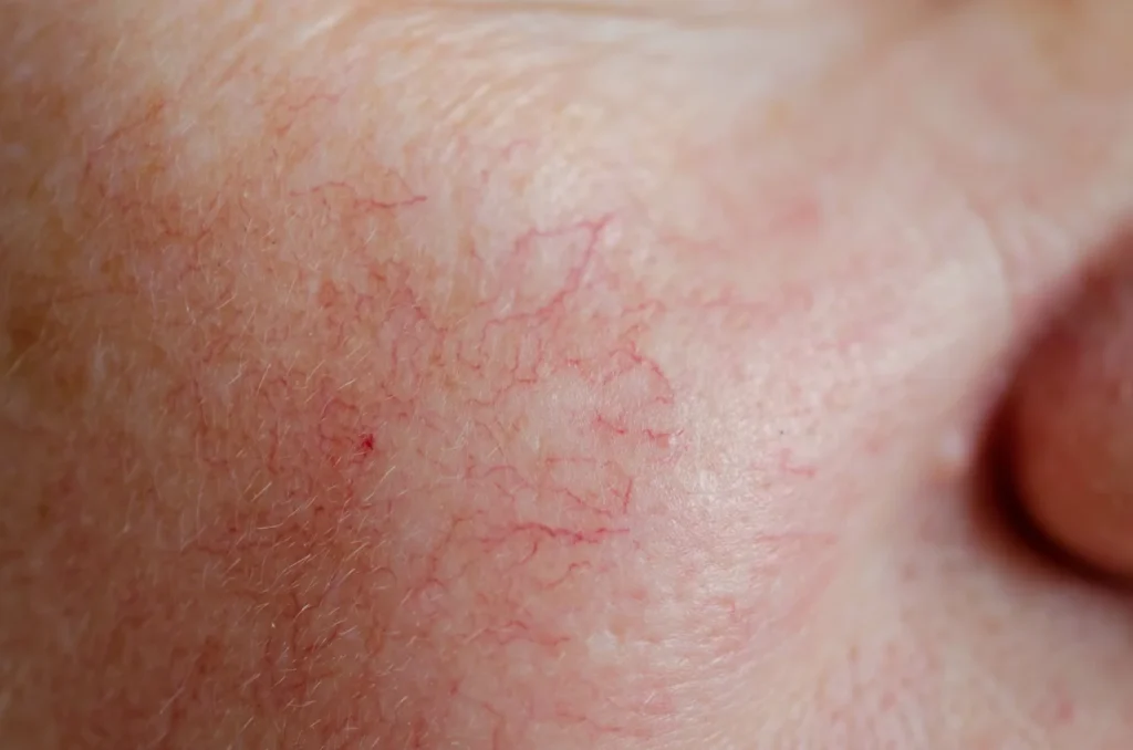 redness blood regenerative aesthetics and dermatology rad laguna hills ca