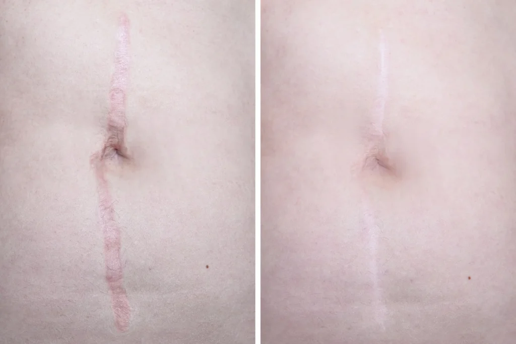 scar treatments regenerative aesthetics and dermatology rad laguna hills ca