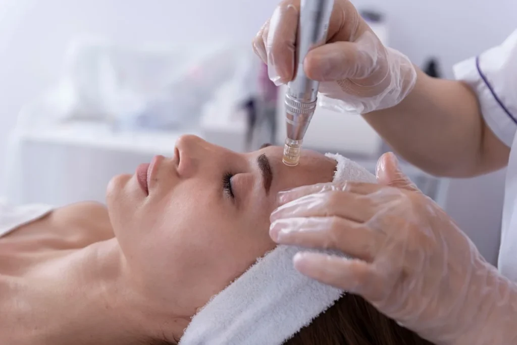 microneedling-regenerative-aesthetics-and-dermatology-rad-laguna-hills-ca