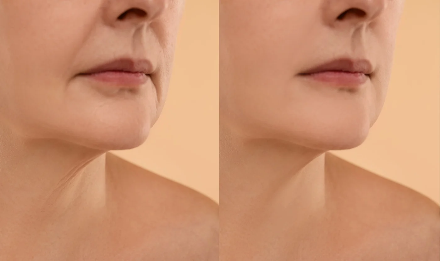 non surgical face and neck regenerative aesthetics and dermatology rad laguna hills ca